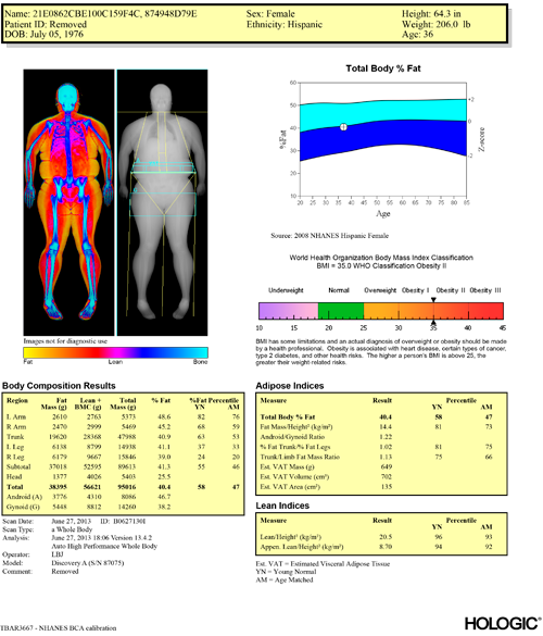 Horizon DXA System | Bone Densitometer | Hologic