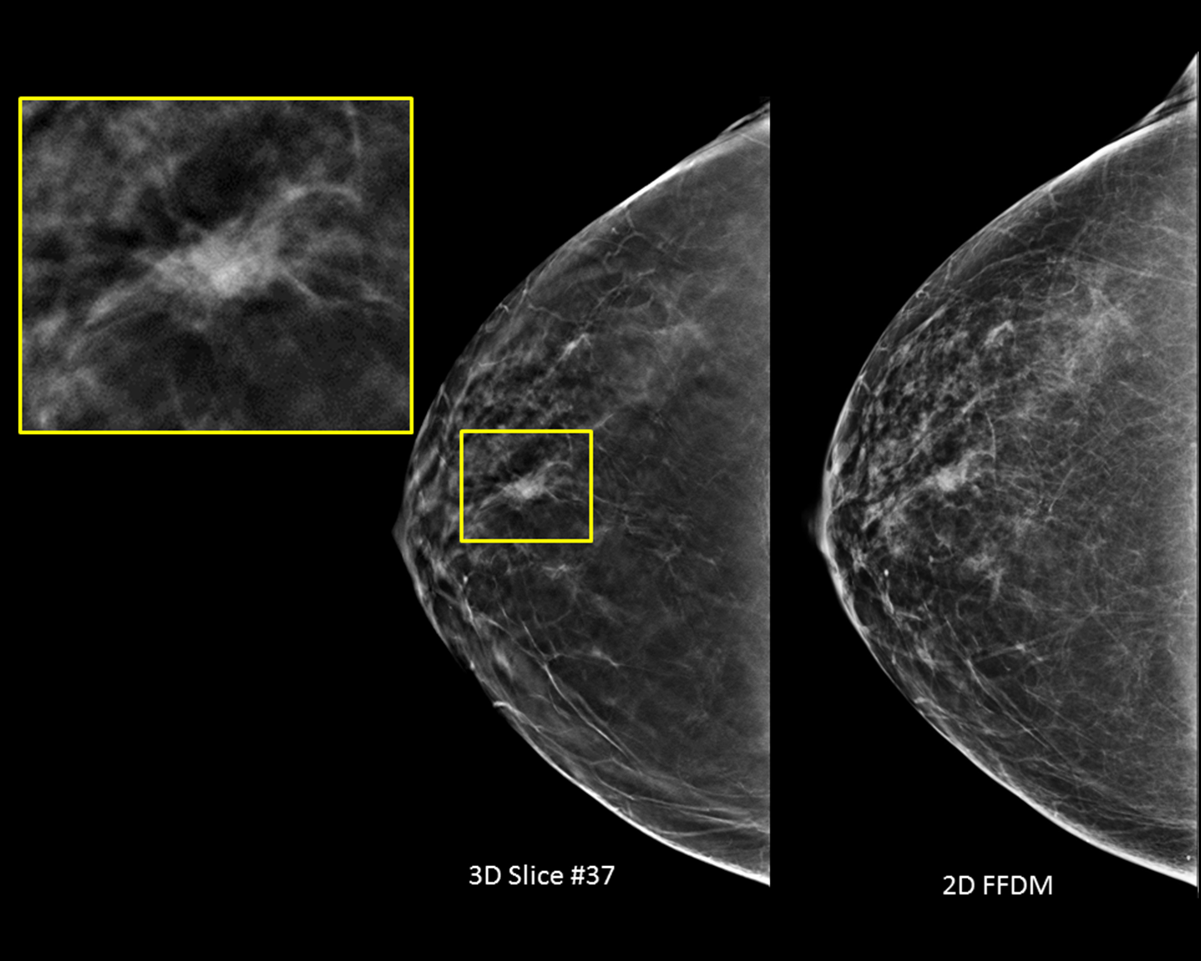 Двухэнергетическая контрастная спектральная маммография