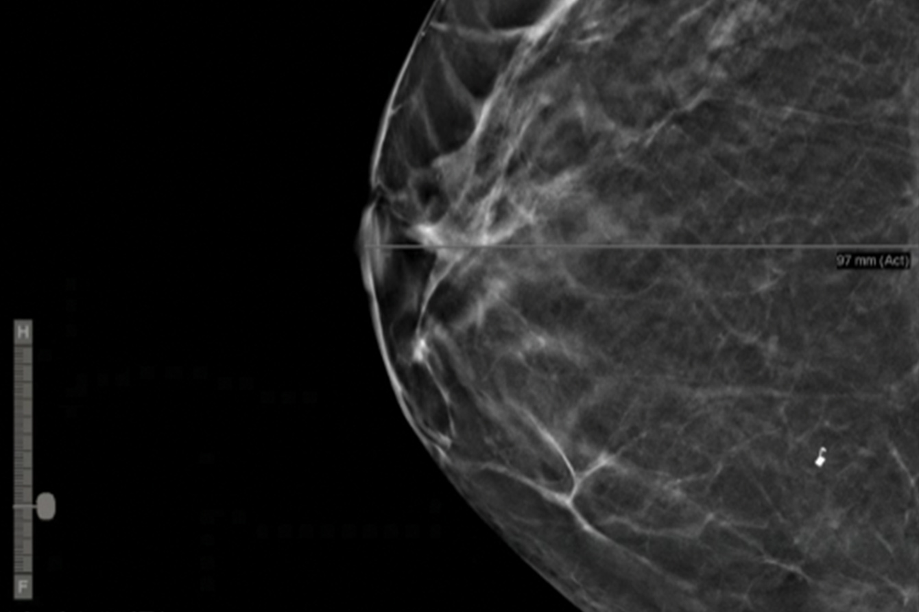 DICOM breast x-ray