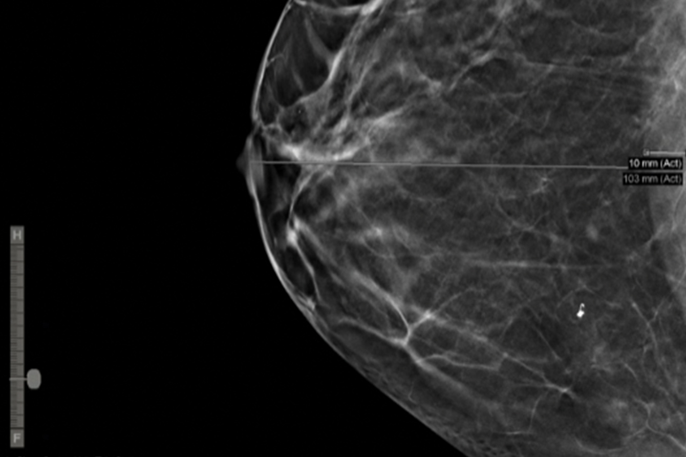 DICOM breast x-ray