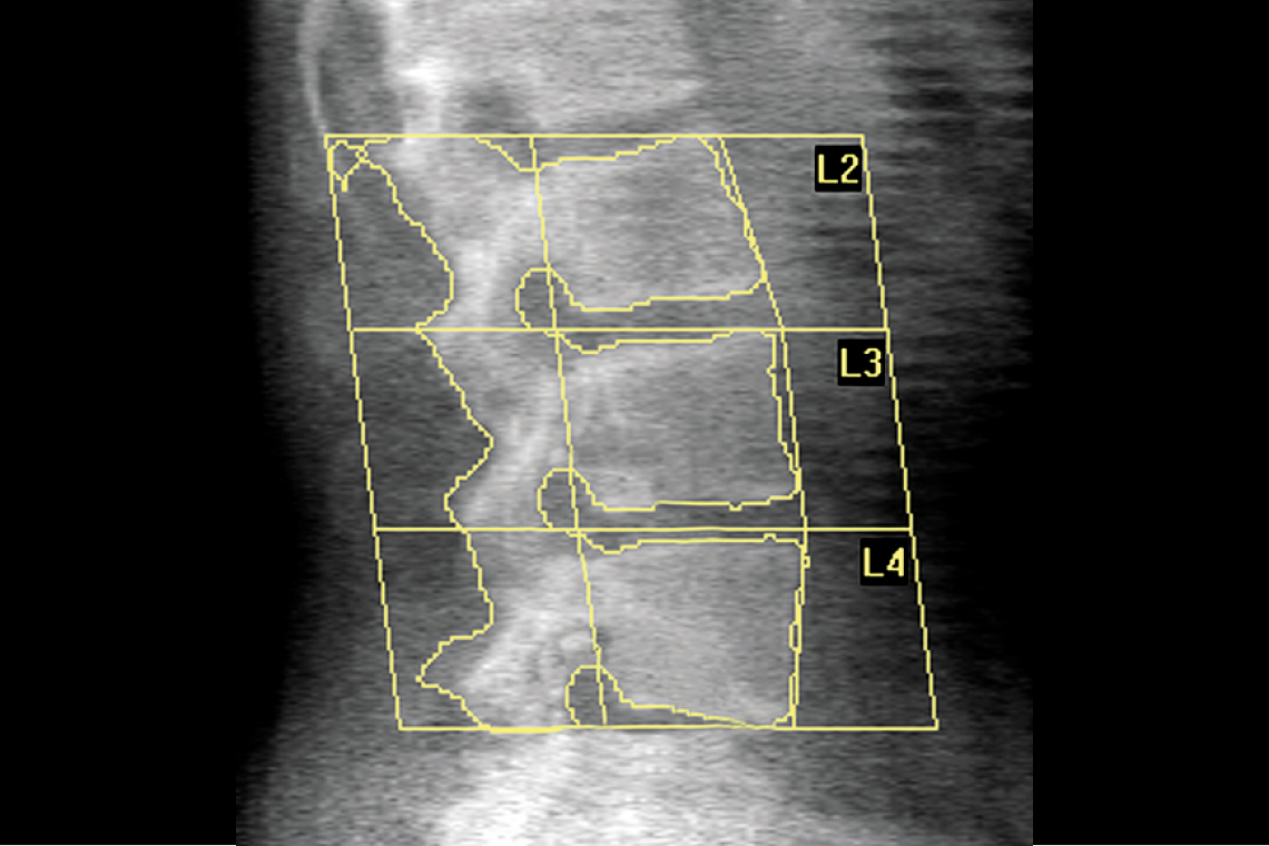 Horizon DXA System Hologic