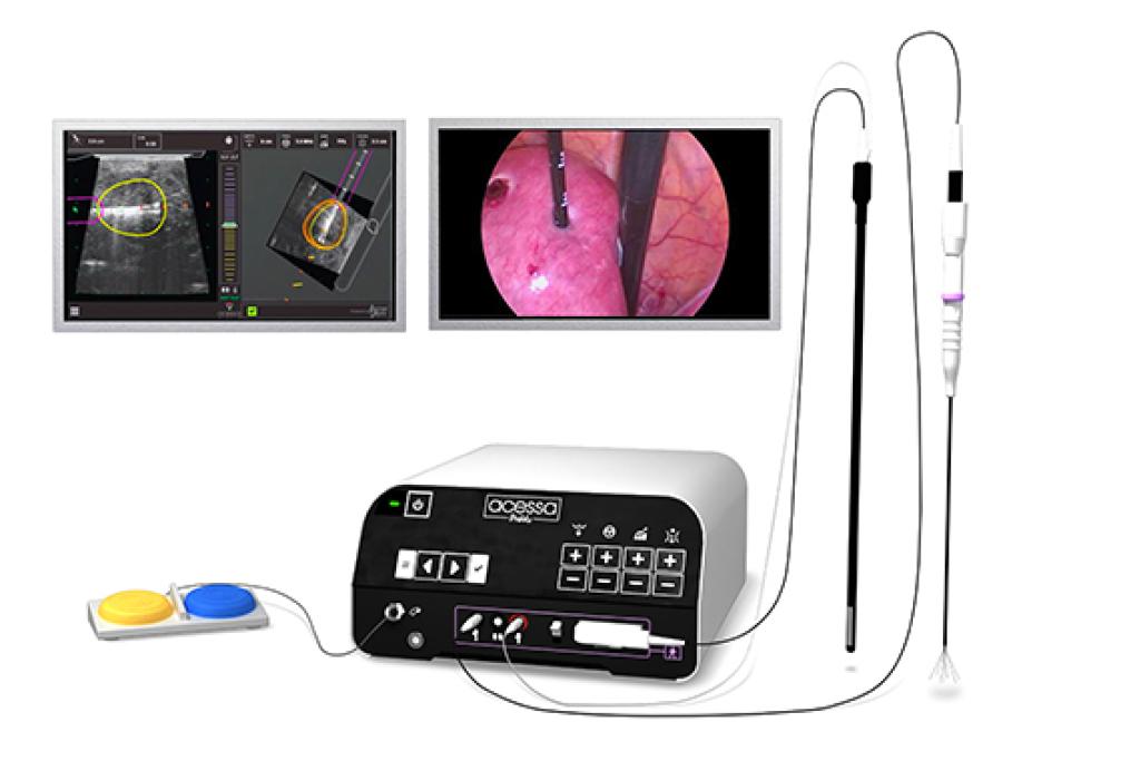 Acessa® Laparoscopic Radiofrequency Ablation (LapRFA) Hologic