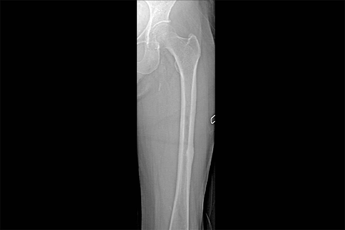 Horizon DXA System From Hologic - Bone Density Scan