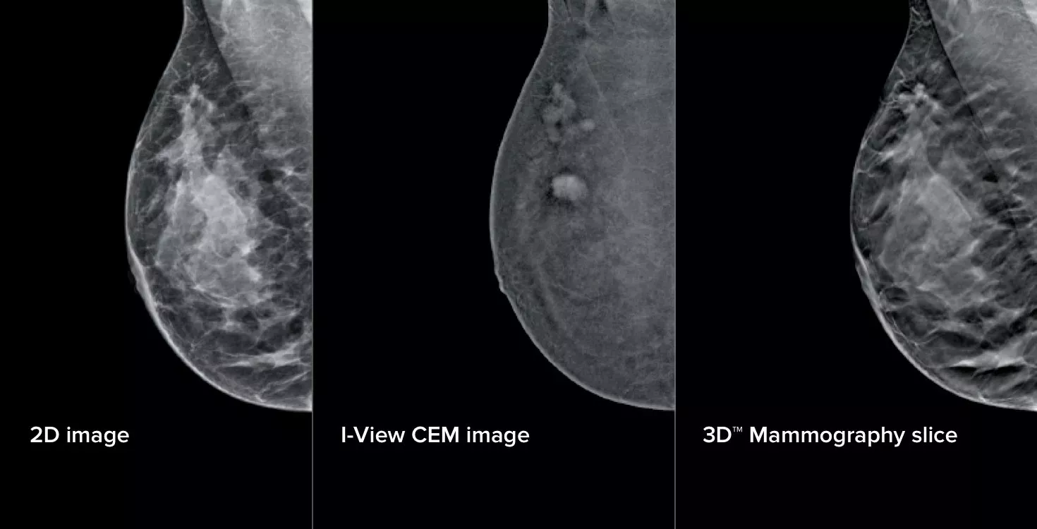 Affirm® Contrast Biopsy Software | Hologic